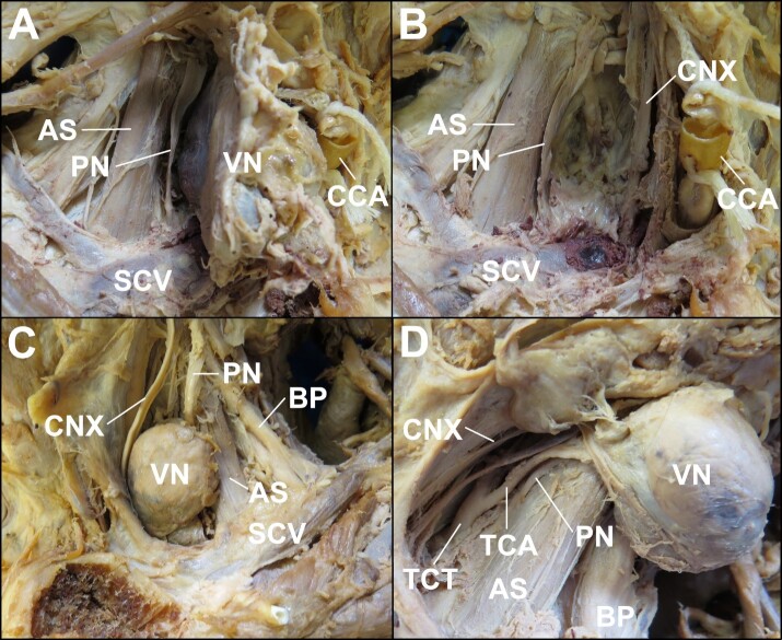 Bilateral Virchow nodes: an unusual finding of pulmonary small-cell neuroendocrine carcinoma metastasis.