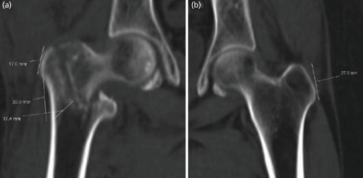 The Role of Computed Tomography and Radiographs in the Management of Intertrochanteric Fractures.