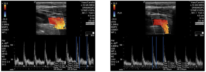 Carotid Flow Time Compared with Invasive Monitoring as a Predictor of Volume Responsiveness in ICU patients.
