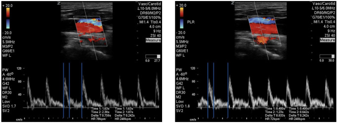 Carotid Flow Time Compared with Invasive Monitoring as a Predictor of Volume Responsiveness in ICU patients.