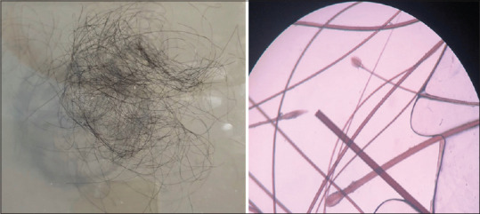 The Paper Sign Test - Assessment, Evaluation, and Diagnosis Method for Reactivated Lichen Planopilaris by Physician and Patient.