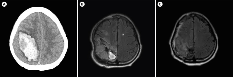 Compensatory Hyperactivity of the Ipsilesional Red Nucleus in a Patient With Somatosensory Cortex Damage: A Case Report.