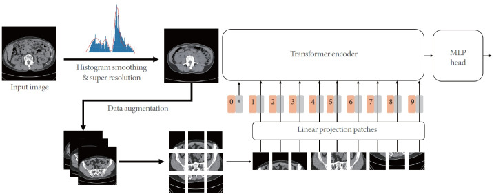 Improved Detection of Urolithiasis Using High-Resolution Computed Tomography Images by a Vision Transformer Model.