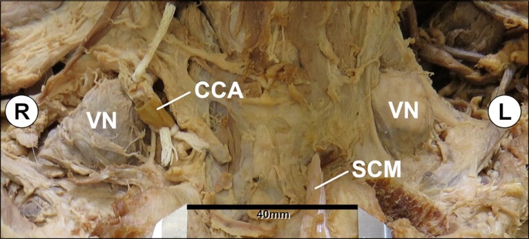 Bilateral Virchow nodes: an unusual finding of pulmonary small-cell neuroendocrine carcinoma metastasis.
