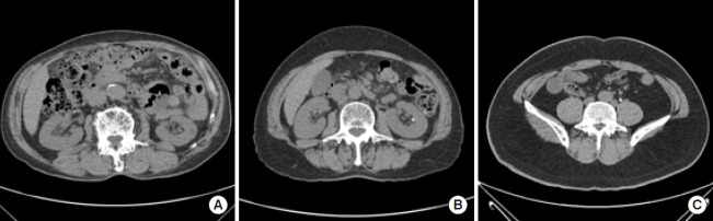 Improved Detection of Urolithiasis Using High-Resolution Computed Tomography Images by a Vision Transformer Model.
