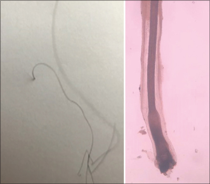 The Paper Sign Test - Assessment, Evaluation, and Diagnosis Method for Reactivated Lichen Planopilaris by Physician and Patient.