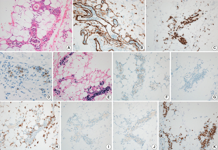 Intravascular NK/T-cell lymphoma: a case report and literature review.