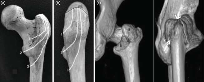 The Role of Computed Tomography and Radiographs in the Management of Intertrochanteric Fractures.