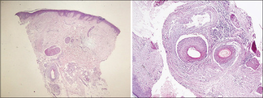 The Paper Sign Test - Assessment, Evaluation, and Diagnosis Method for Reactivated Lichen Planopilaris by Physician and Patient.