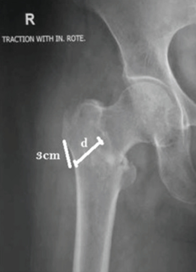 The Role of Computed Tomography and Radiographs in the Management of Intertrochanteric Fractures.