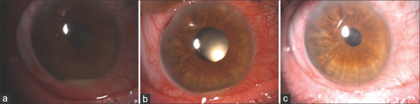 Unusual Inflammatory Clinical Presentation After Cataract Surgery and that Thought-provoking Question: Is this Infection or Toxic Anterior Segment Syndrome?