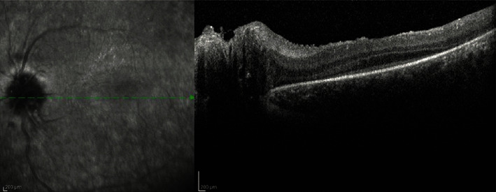 Alström's Syndrome, Leber's Hereditary Optic Neuropathy, or Retinitis Pigmentosa? A Case of Misdiagnosis.