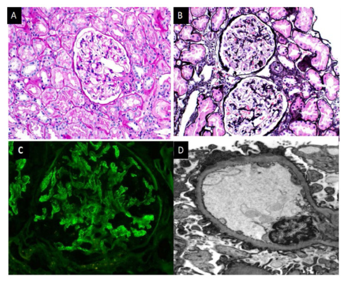 Lipoic Acid as a Trigger for NELL-1 Positive Membranous Nephropathy.