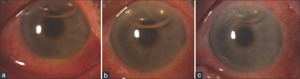 Unusual Inflammatory Clinical Presentation After Cataract Surgery and that Thought-provoking Question: Is this Infection or Toxic Anterior Segment Syndrome?