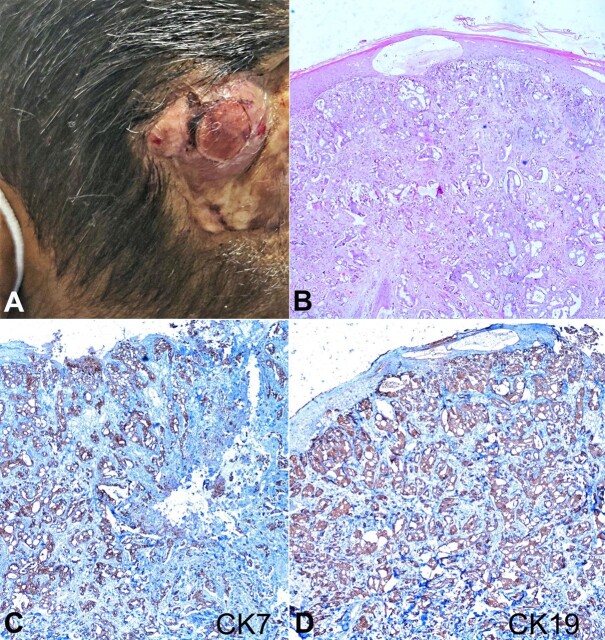 Gallbladder adenocarcinoma skin metastasis.