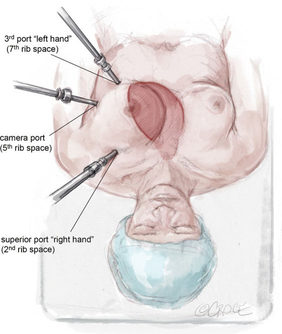 Minimally invasive surgical coronary artery bypass in women.