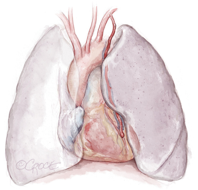 Minimally invasive surgical coronary artery bypass in women.