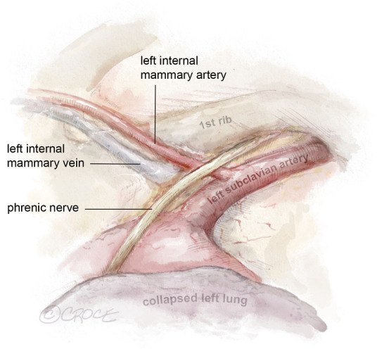 Minimally invasive surgical coronary artery bypass in women.