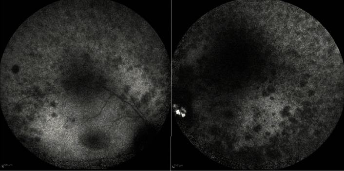 Alström's Syndrome, Leber's Hereditary Optic Neuropathy, or Retinitis Pigmentosa? A Case of Misdiagnosis.