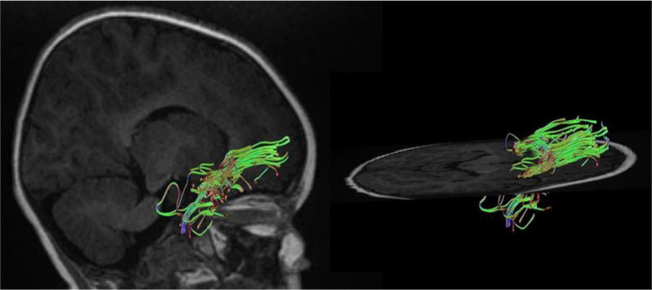 Alterations in Diffusion Tensor Imaging-derived Indices of Auditory Pathway-related Fiber Tracts in Children With Sensorineural Hearing Loss.