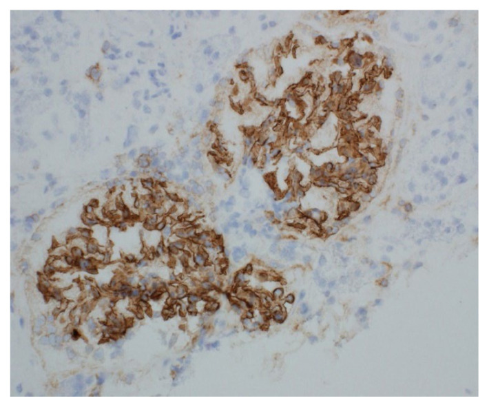 Lipoic Acid as a Trigger for NELL-1 Positive Membranous Nephropathy.