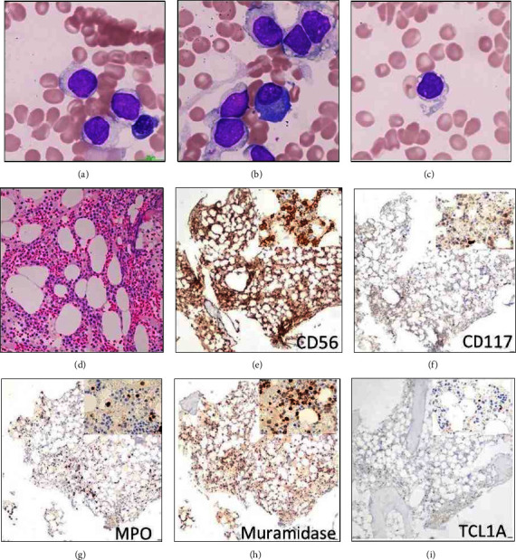 A Case of Acute Myeloid Leukemia Mimicking Blastic Plasmacytoid Dendritic Cell Neoplasm: Utility of the Proposed Upcoming WHO-5 Diagnostic Criteria.