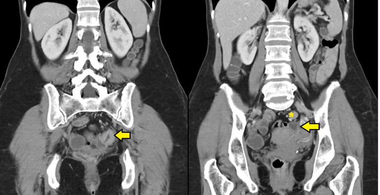 Successful outpatient conservative management of chyle leak after laparoscopic left hemicolectomy.