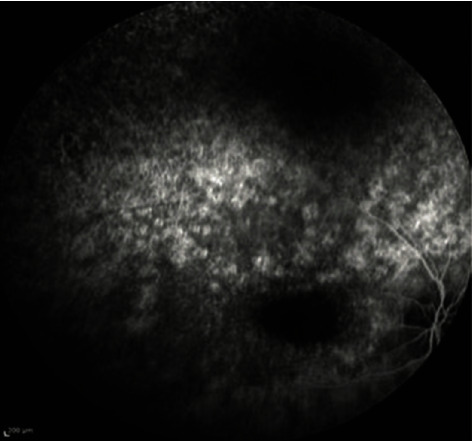 Alström's Syndrome, Leber's Hereditary Optic Neuropathy, or Retinitis Pigmentosa? A Case of Misdiagnosis.