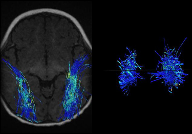 Alterations in Diffusion Tensor Imaging-derived Indices of Auditory Pathway-related Fiber Tracts in Children With Sensorineural Hearing Loss.