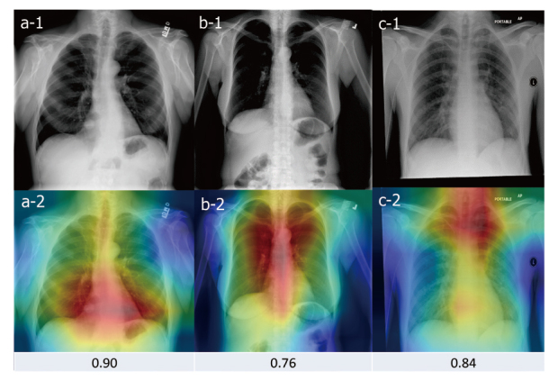 Development of a novel artificial intelligence algorithm to detect pulmonary nodules on chest radiography.