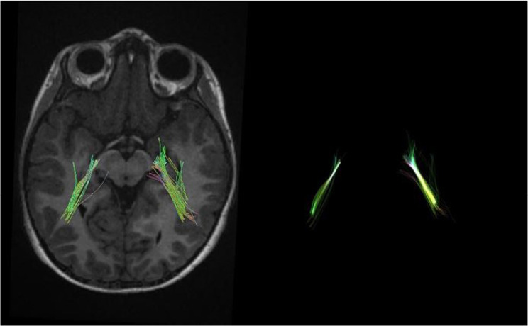 Alterations in Diffusion Tensor Imaging-derived Indices of Auditory Pathway-related Fiber Tracts in Children With Sensorineural Hearing Loss.