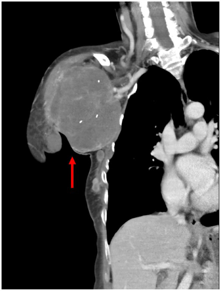 Metaplastic Carcinoma of the Axillary Breast With Heterologous Mesenchymal (Chondroid) Differentiation: A Difficult Case and Literature Review.