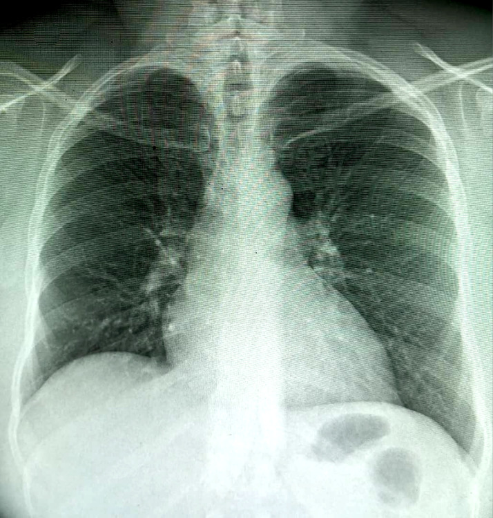 [Ear tuberculosis concomitant with pulmonary localization in an HIV-immunosuppressed patient, in Bamako, Mali].
