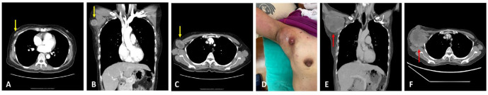 Metaplastic Carcinoma of the Axillary Breast With Heterologous Mesenchymal (Chondroid) Differentiation: A Difficult Case and Literature Review.