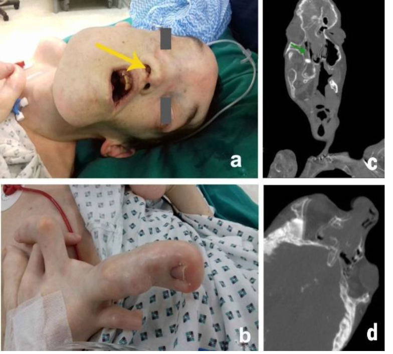Sinonasal Neuroendocrine Carcinoma in Adult Proteus Syndrome.