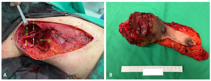 Metaplastic Carcinoma of the Axillary Breast With Heterologous Mesenchymal (Chondroid) Differentiation: A Difficult Case and Literature Review.