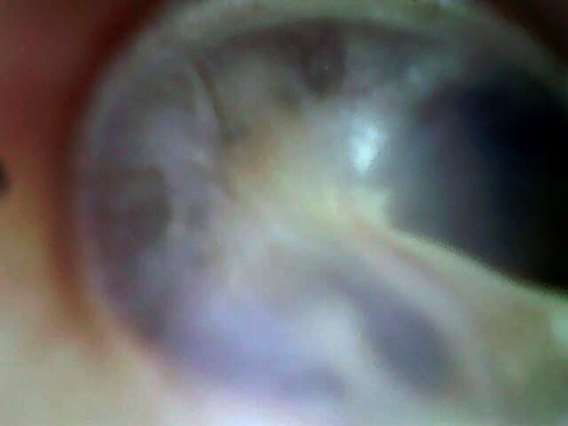 [Ear tuberculosis concomitant with pulmonary localization in an HIV-immunosuppressed patient, in Bamako, Mali].