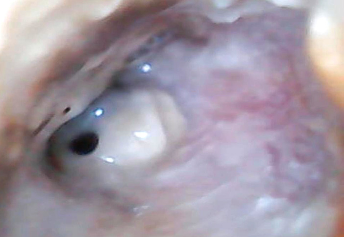 [Ear tuberculosis concomitant with pulmonary localization in an HIV-immunosuppressed patient, in Bamako, Mali].