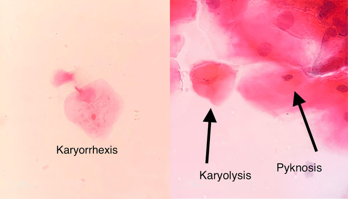 Genotoxic and Cytotoxic Effects of Cone Beam Computed Tomography and Multidetector Computed Tomography on Exfoliated Buccal Epithelial Cells.