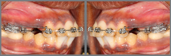 Does leukocyte-platelet-rich fibrin (L-PRF) cause long term acceleration in the rate of canine retraction? A split-mouth, two-arm parallel group, randomized control trial.