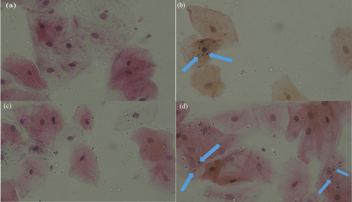 Genotoxic and Cytotoxic Effects of Cone Beam Computed Tomography and Multidetector Computed Tomography on Exfoliated Buccal Epithelial Cells.