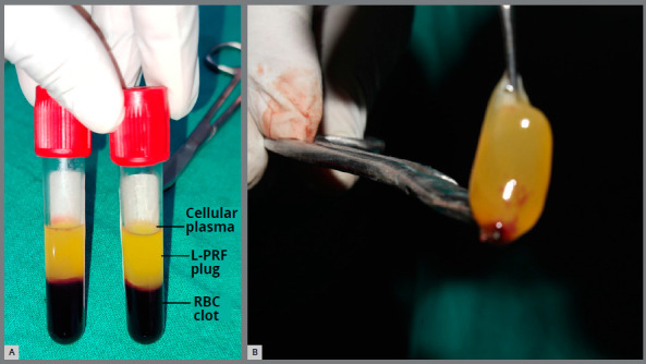 Does leukocyte-platelet-rich fibrin (L-PRF) cause long term acceleration in the rate of canine retraction? A split-mouth, two-arm parallel group, randomized control trial.