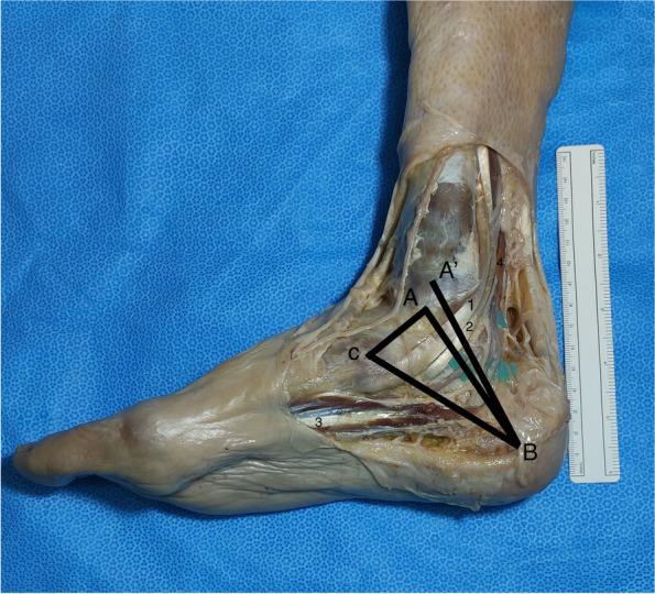 An anatomical approach to the tarsal tunnel syndrome: what can ankle's medial side anatomy reveal to us?