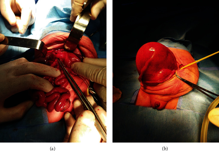 Prune Belly Syndrome in a Female Newborn following In Vitro Fertilization-Induced Pregnancy: A Case Report and Literature Review.