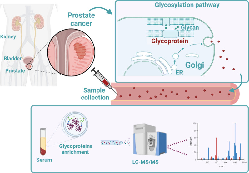 Development of a predictive model to distinguish prostate cancer from benign prostatic hyperplasia by integrating serum glycoproteomics and clinical variables.