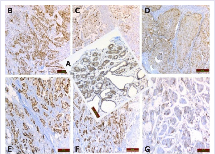 The overexpression of cyclin D1 is a positive prognostic factor in advanced-stage breast carcinoma cases.