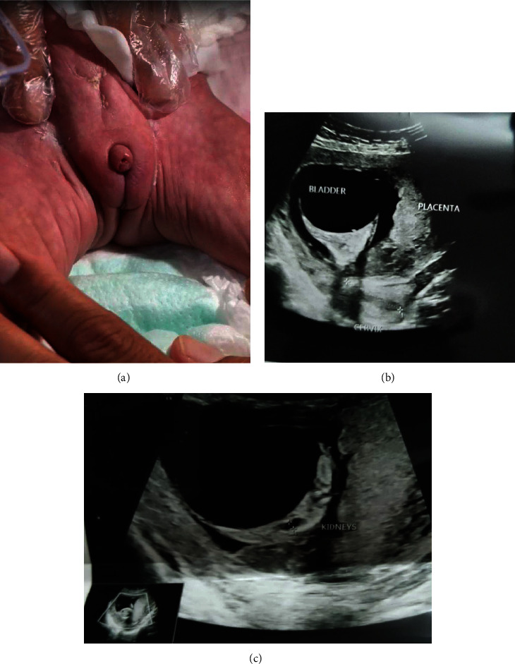 Prune Belly Syndrome in a Female Newborn following In Vitro Fertilization-Induced Pregnancy: A Case Report and Literature Review.
