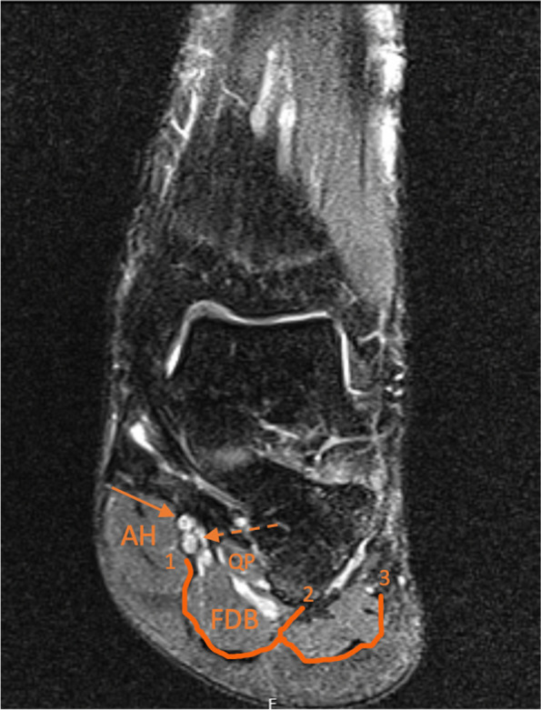 An anatomical approach to the tarsal tunnel syndrome: what can ankle's medial side anatomy reveal to us?