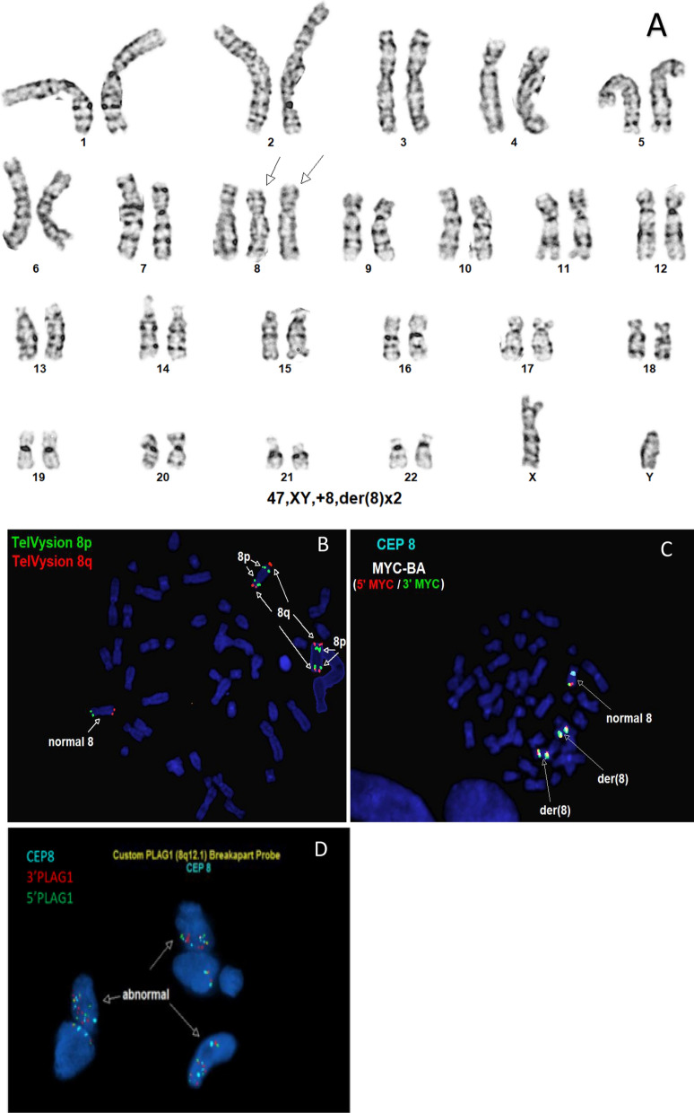 Chromothripsis in lipoblastoma: second reported case with complex PLAG1 rearrangement.