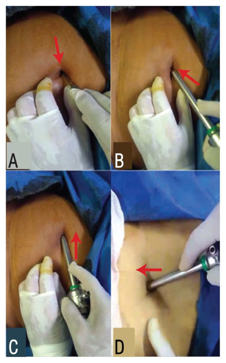 Intraoperative and Postoperative Outcomes of Modified Bidirectional Intra-Umbilical Incision versus Infra-Umbilical Incision for Direct Trocar Insertion in Gynaecological Laparoscopy: A randomised controlled trial.